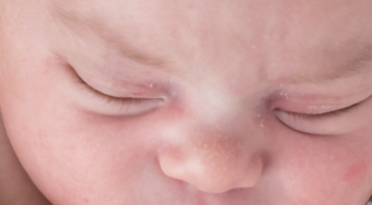 Milk Spots and Skin Flakes Newborn Photoshop Action - Dallas, Texas ...