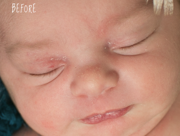 milk bumps and skin flakiness newborn photoshop action